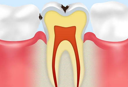 2．虫歯発生のメカニズム