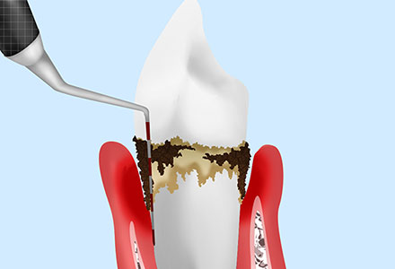 2. 歯周病は体の健康にも影響を及ぼす
