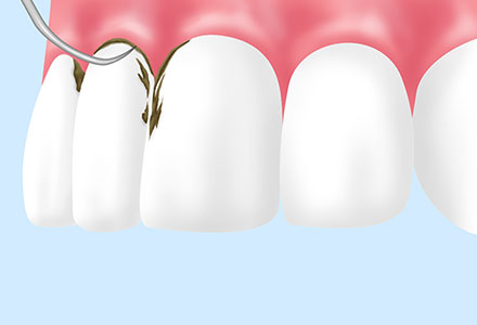 歯石の除去（スケーリング）