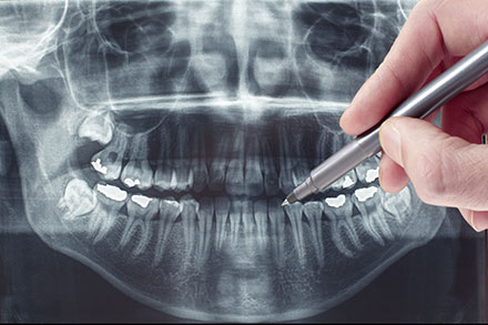 3. 親知らずを安全に抜歯するために―歯科用CTのご案内―
